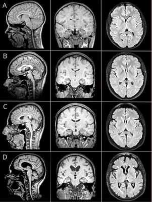 Brain Morphometry and Cognitive Performance in Normal Brain Aging: Age- and Sex-Related Structural and Functional Changes